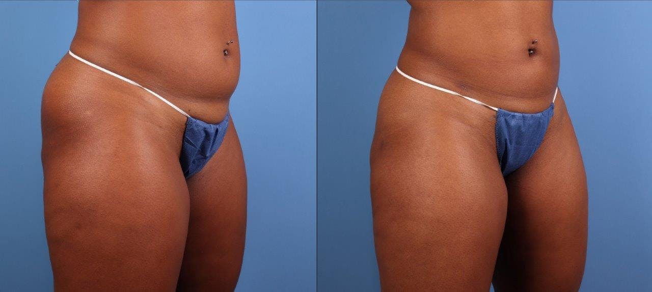 Abdomen Before & After Gallery - Patient 281383 - Image 5