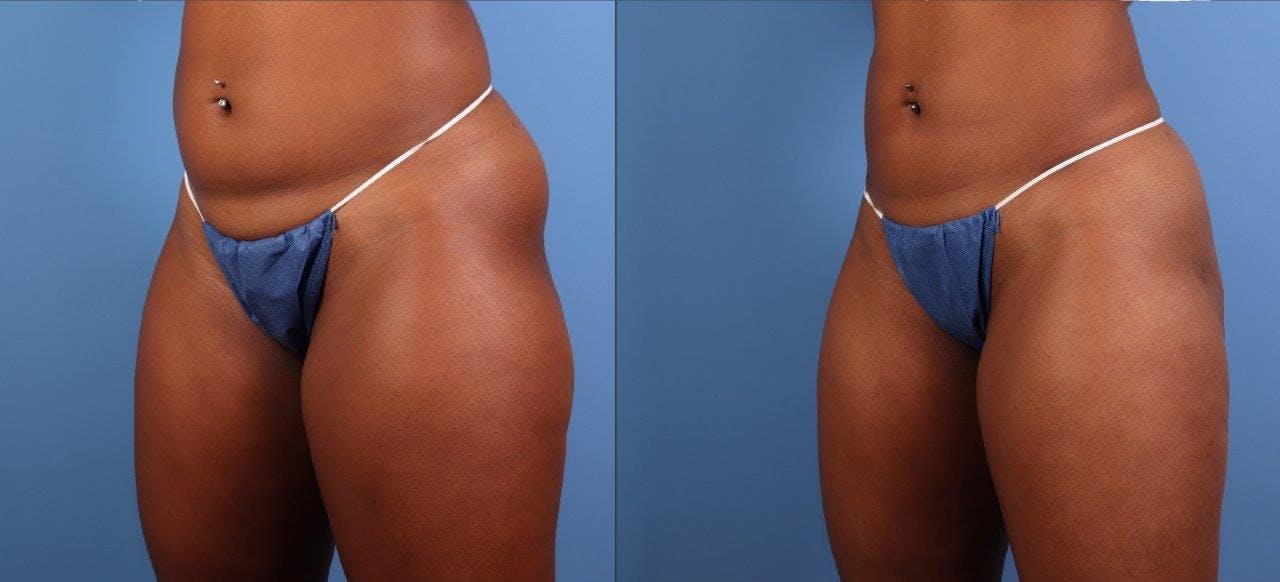 Abdomen Before & After Gallery - Patient 281383 - Image 6