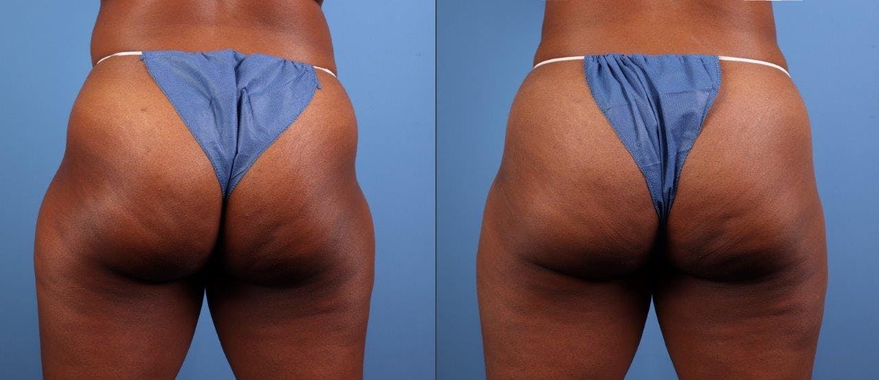 Abdomen Before & After Gallery - Patient 281383 - Image 7