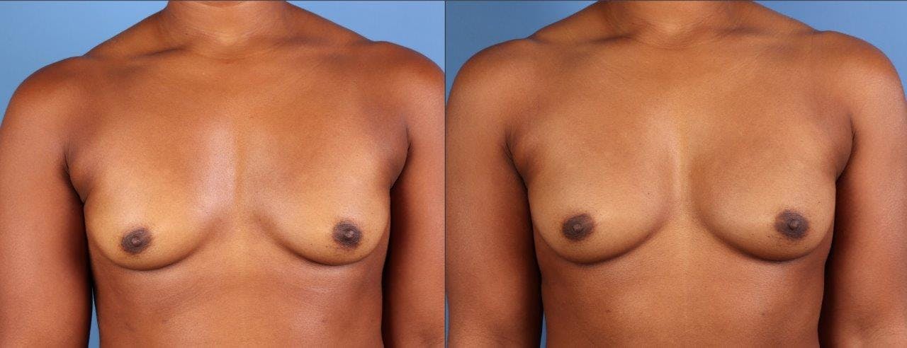Abdomen Before & After Gallery - Patient 281383 - Image 9
