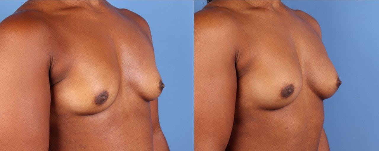 Abdomen Before & After Gallery - Patient 281383 - Image 10