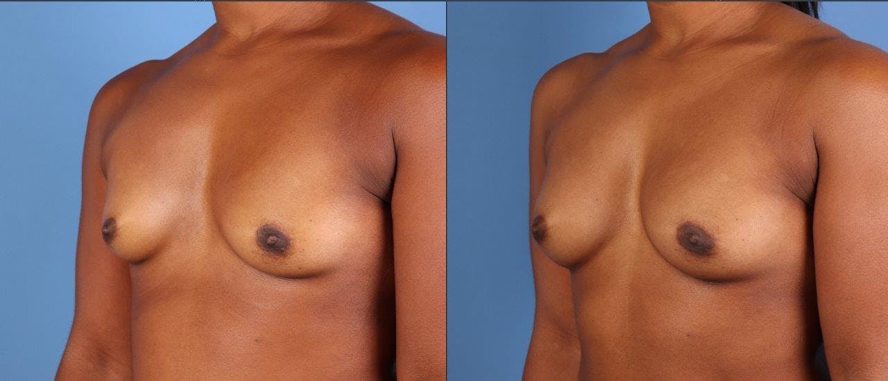 Abdomen Before & After Gallery - Patient 281383 - Image 12