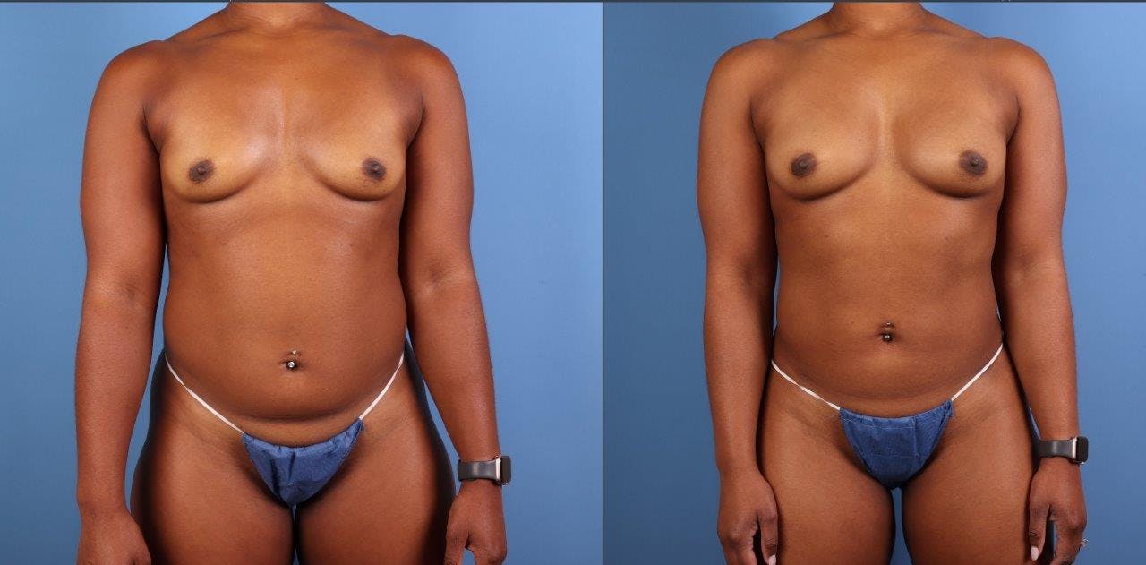 Abdomen Before & After Gallery - Patient 281383 - Image 8