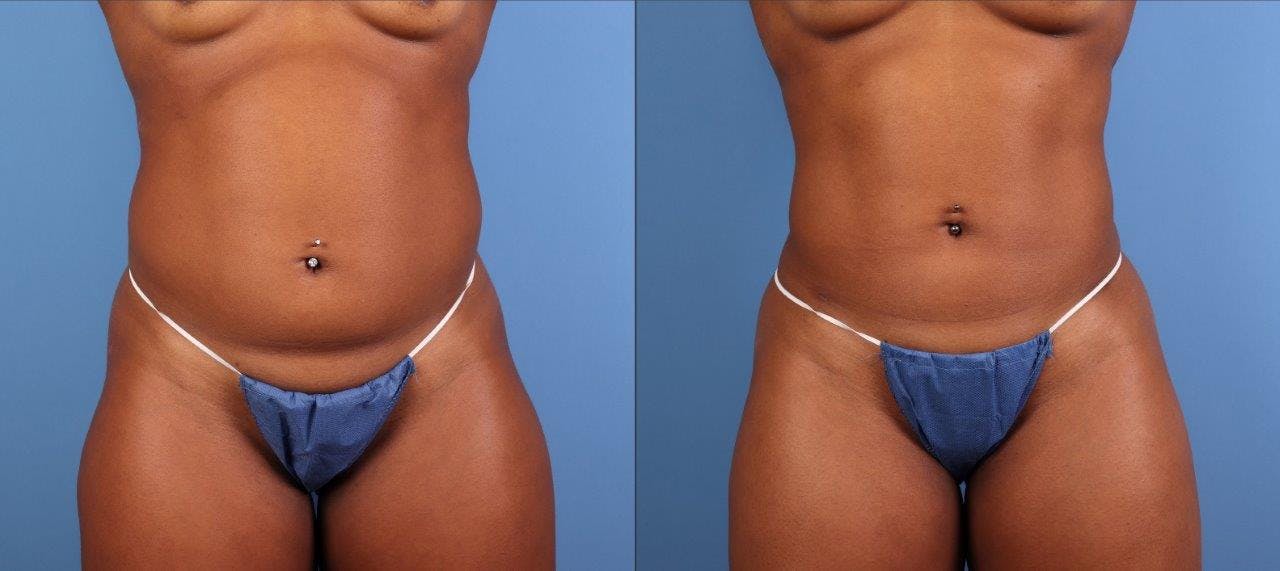Abdomen Before & After Gallery - Patient 281383 - Image 1