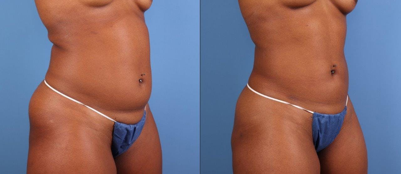 Abdomen Before & After Gallery - Patient 281383 - Image 2