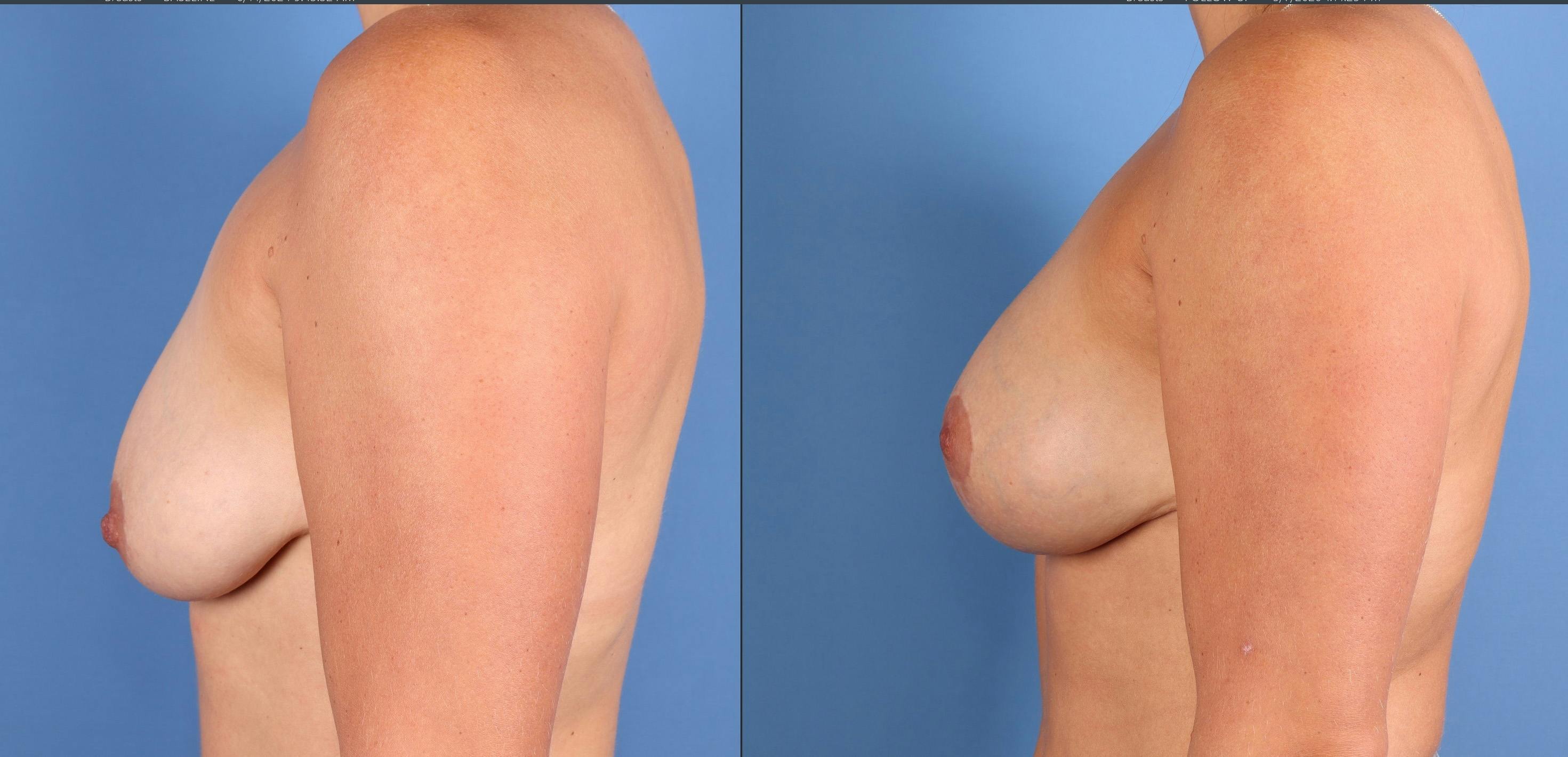 Breast Lift with Augmentation Before & After Gallery - Patient 110756 - Image 5