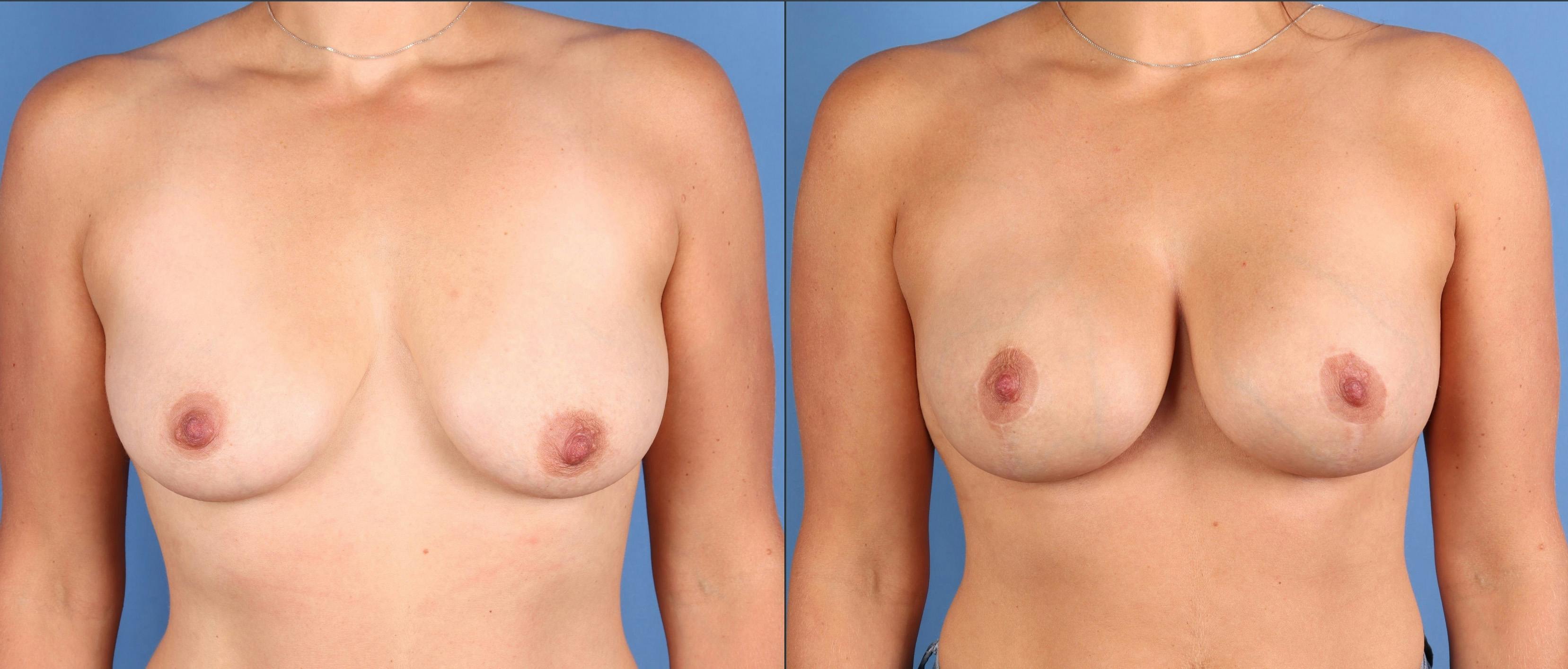 Breast Lift with Augmentation Before & After Gallery - Patient 110756 - Image 1