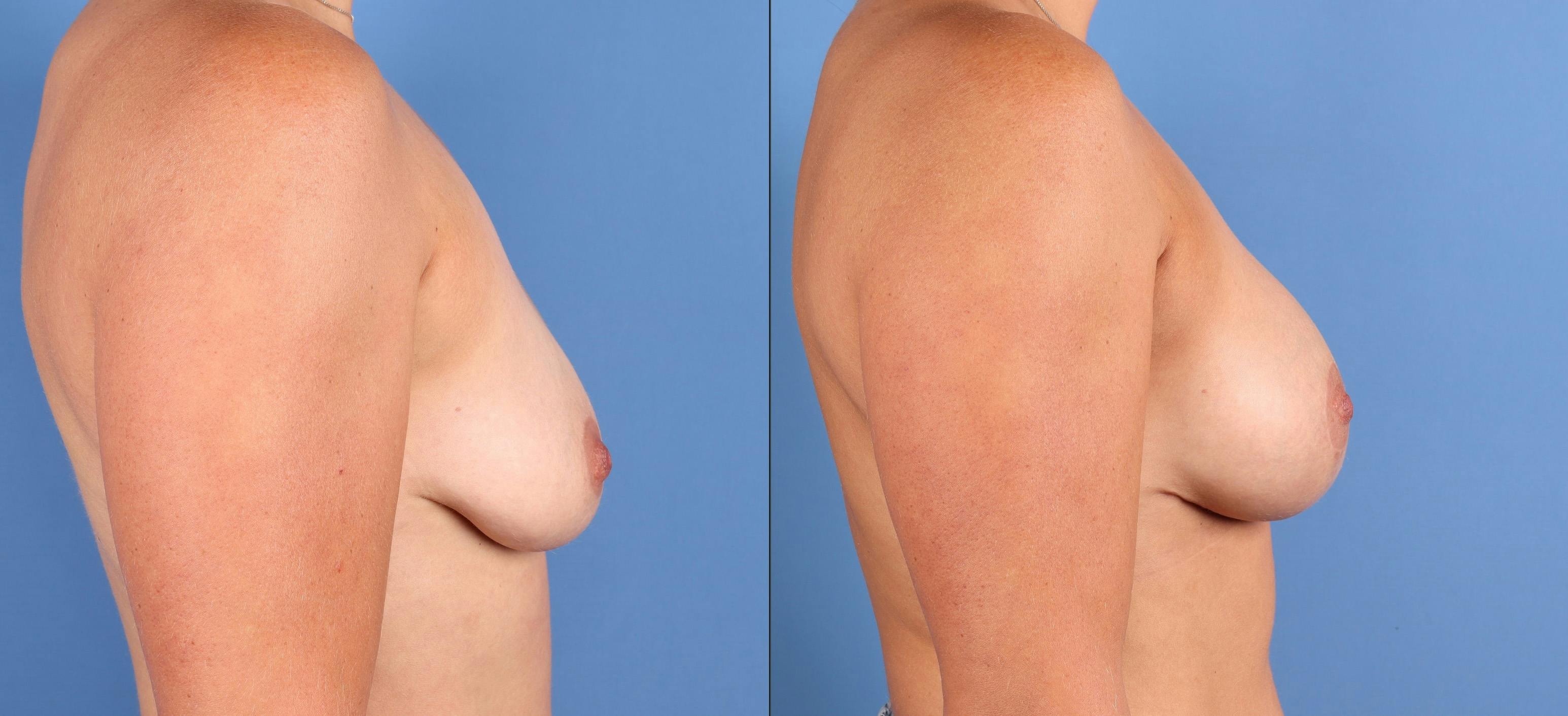 Breast Lift with Augmentation Before & After Gallery - Patient 110756 - Image 3