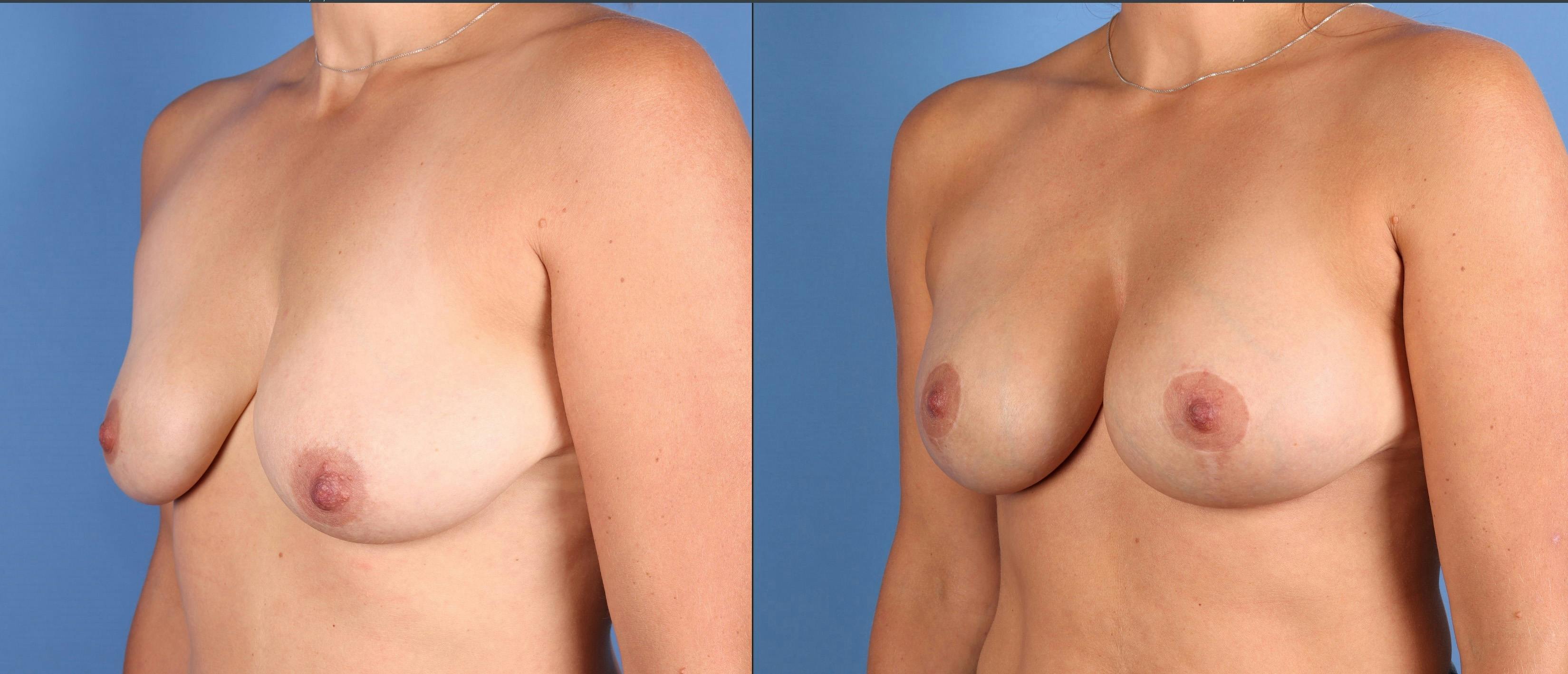 Breast Lift with Augmentation Before & After Gallery - Patient 110756 - Image 4