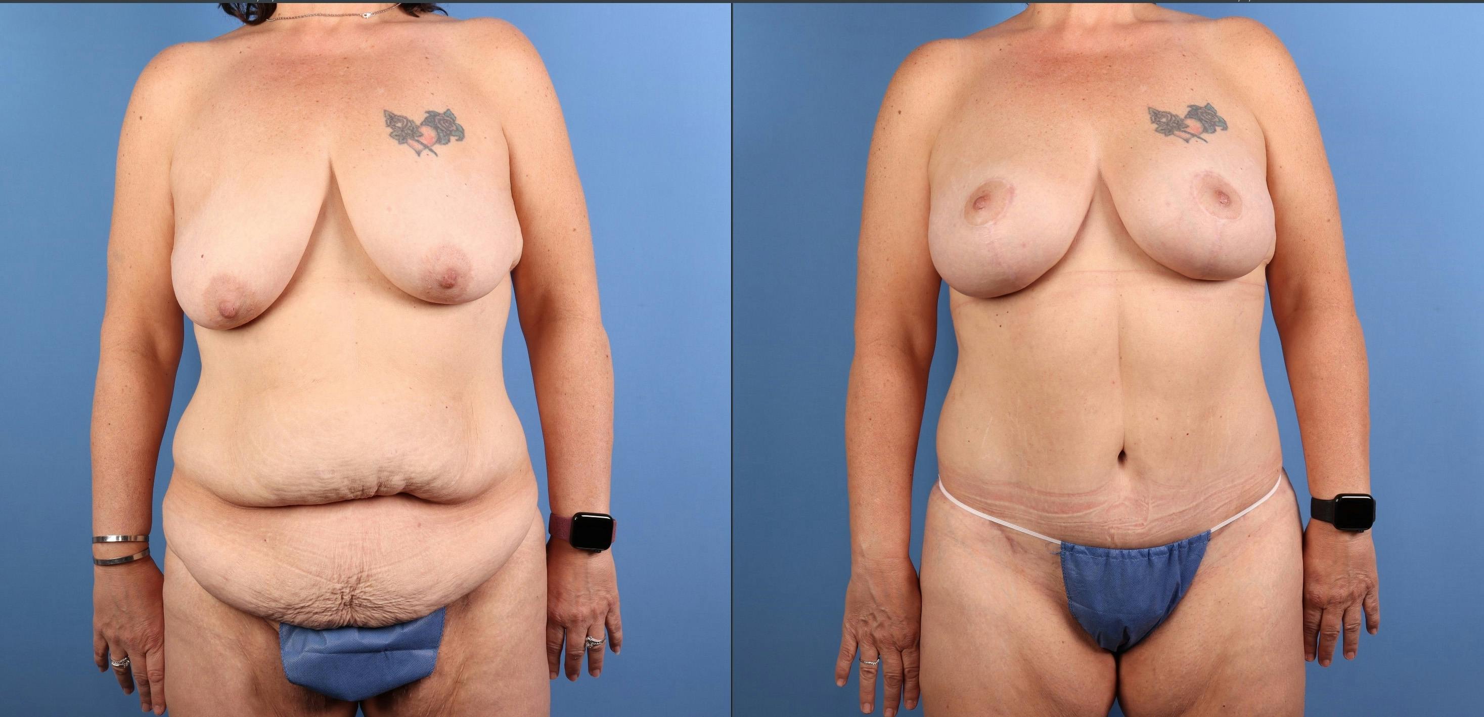 Tummy Tuck Before & After Gallery - Patient 294341 - Image 9