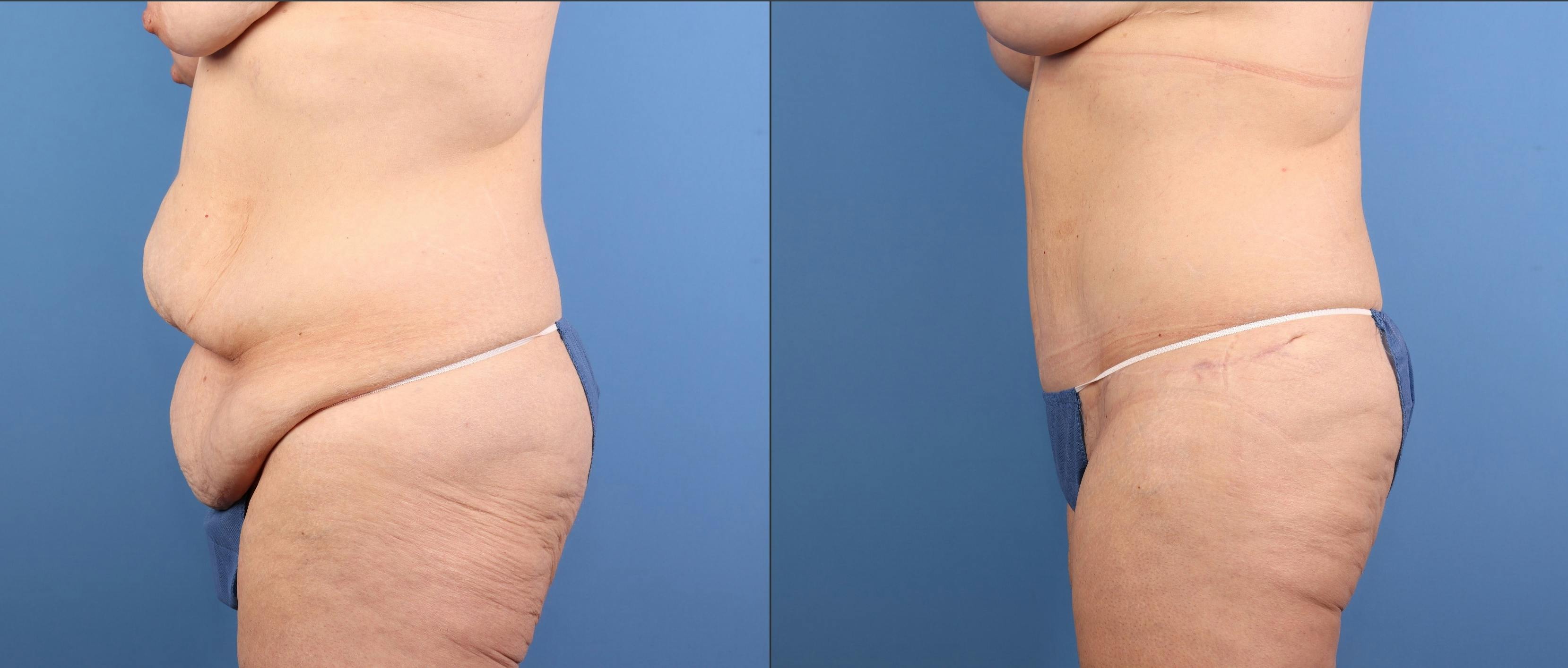 Tummy Tuck Before & After Gallery - Patient 294341 - Image 5