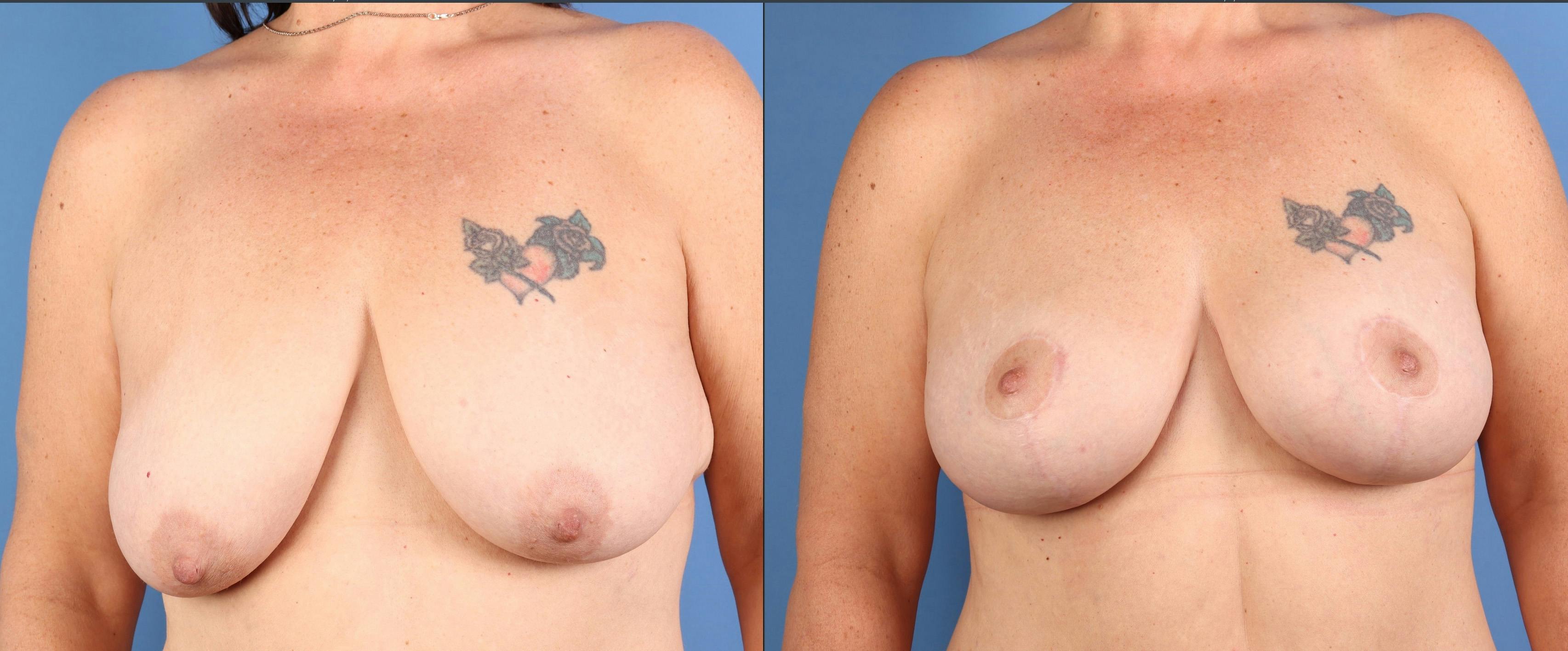 Tummy Tuck Before & After Gallery - Patient 294341 - Image 6