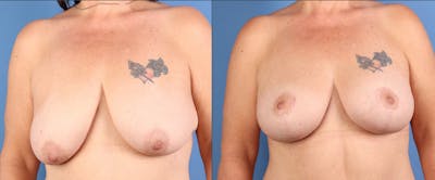 Breast Lift with Augmentation Before & After Gallery - Patient 363033 - Image 1