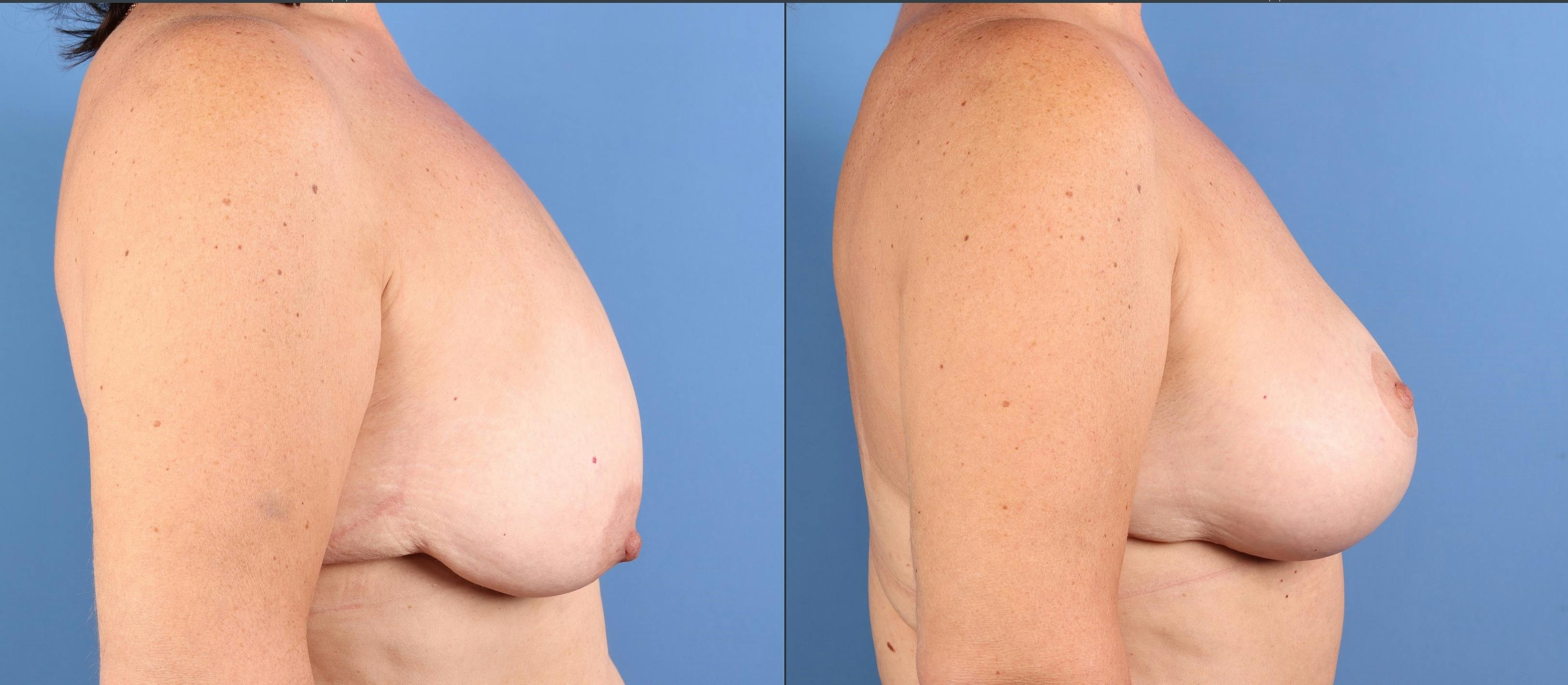 Tummy Tuck Before & After Gallery - Patient 294341 - Image 8