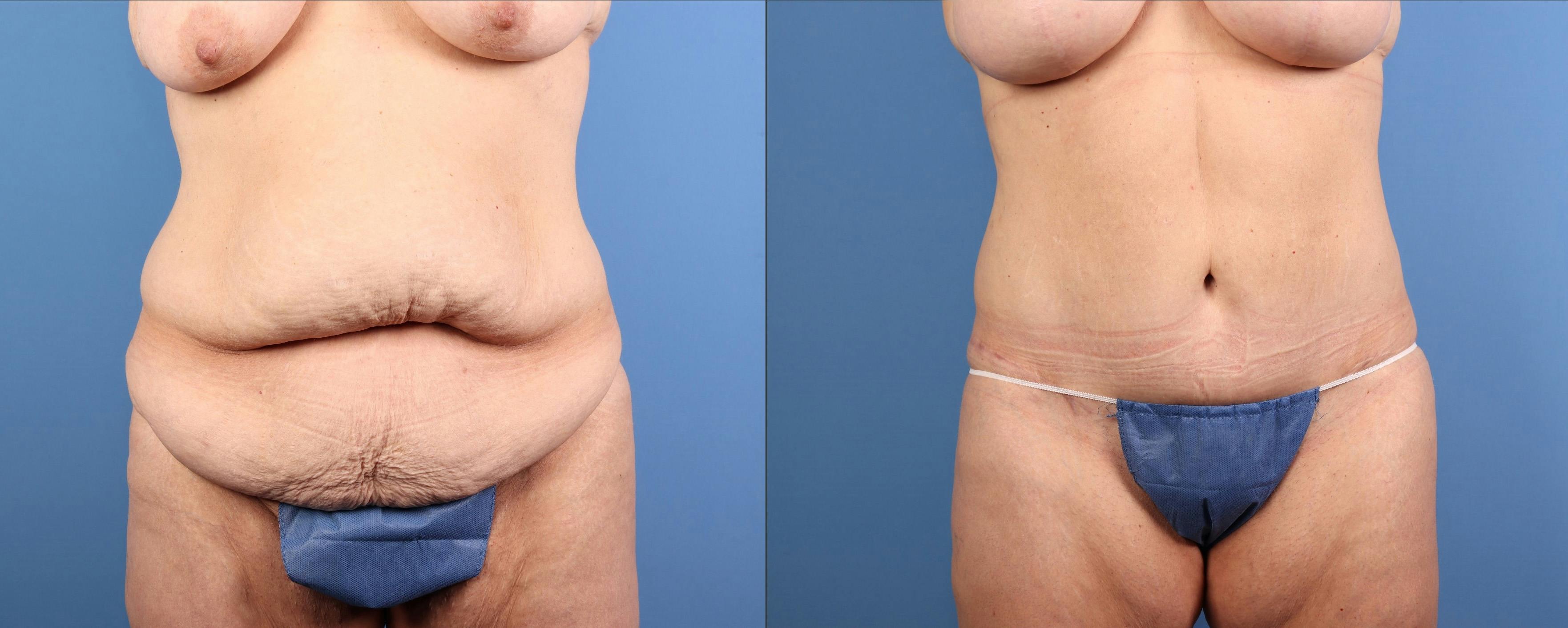 Tummy Tuck Before & After Gallery - Patient 294341 - Image 1