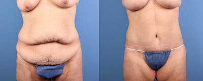 Tummy Tuck Before & After Gallery - Patient 280741 - Image 1