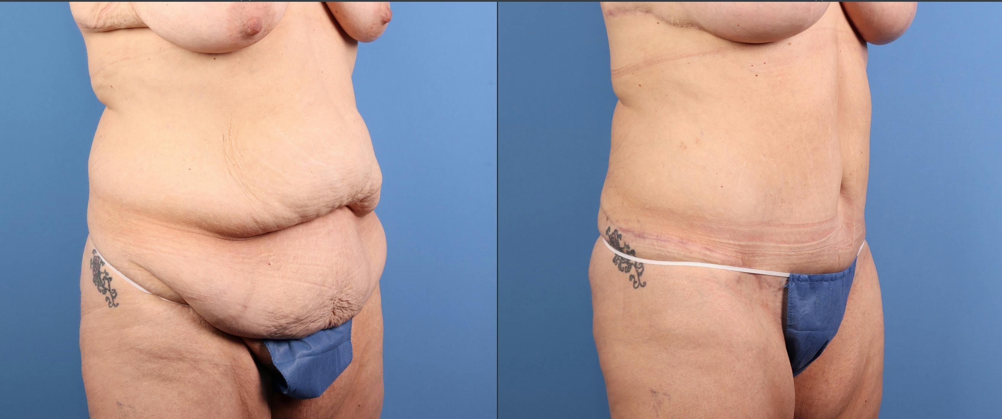 Tummy Tuck Before & After Gallery - Patient 294341 - Image 2