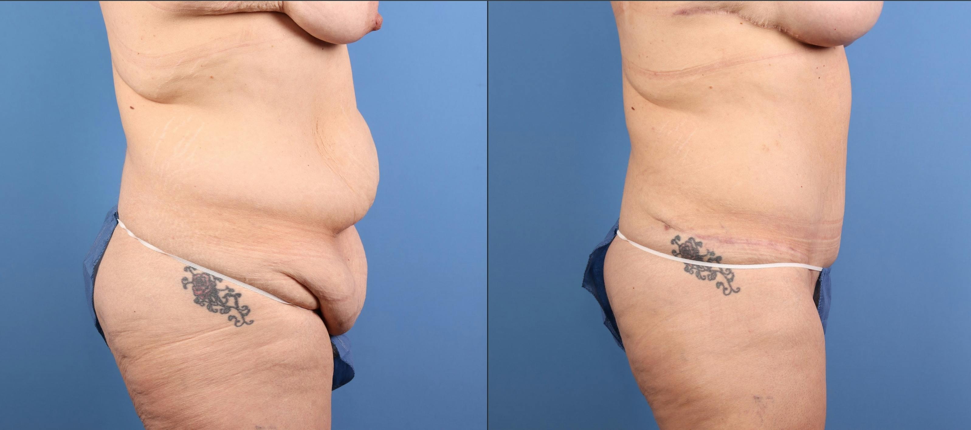 Tummy Tuck Before & After Gallery - Patient 294341 - Image 3