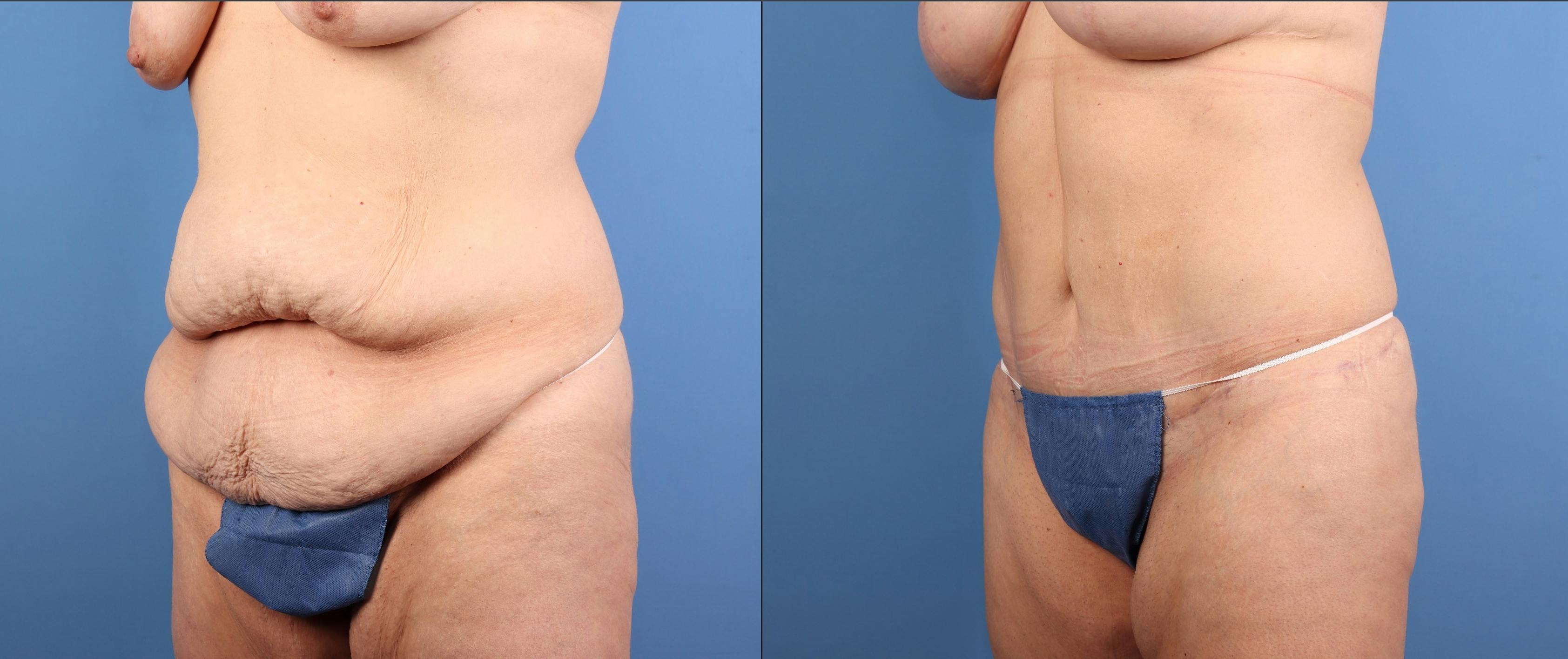 Tummy Tuck Before & After Gallery - Patient 294341 - Image 4