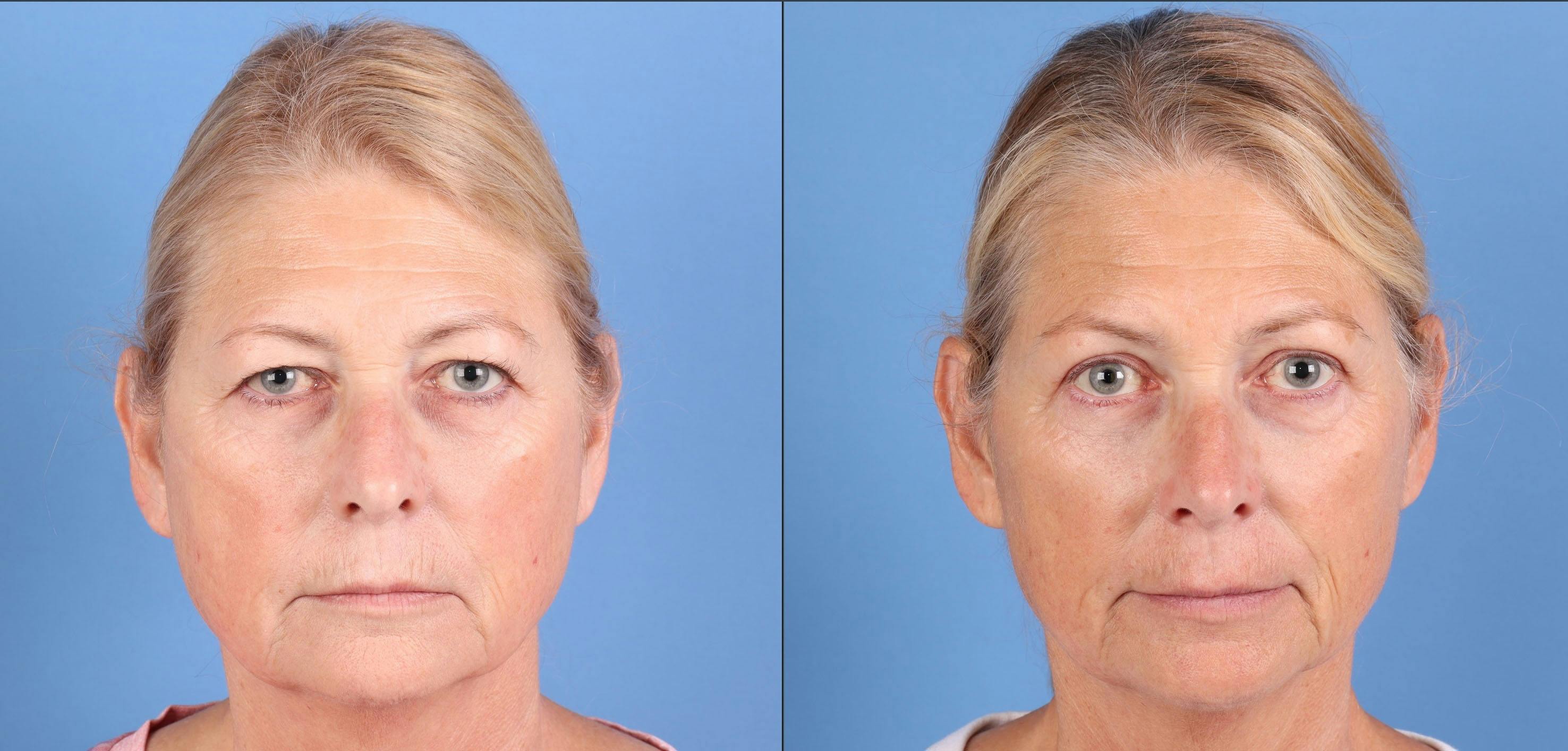 Eyelid Surgery (Upper Blepharoplasty) Before & After Gallery - Patient 317418 - Image 1