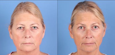 Eyelid Surgery (Upper Blepharoplasty) Before & After Gallery - Patient 317418 - Image 1