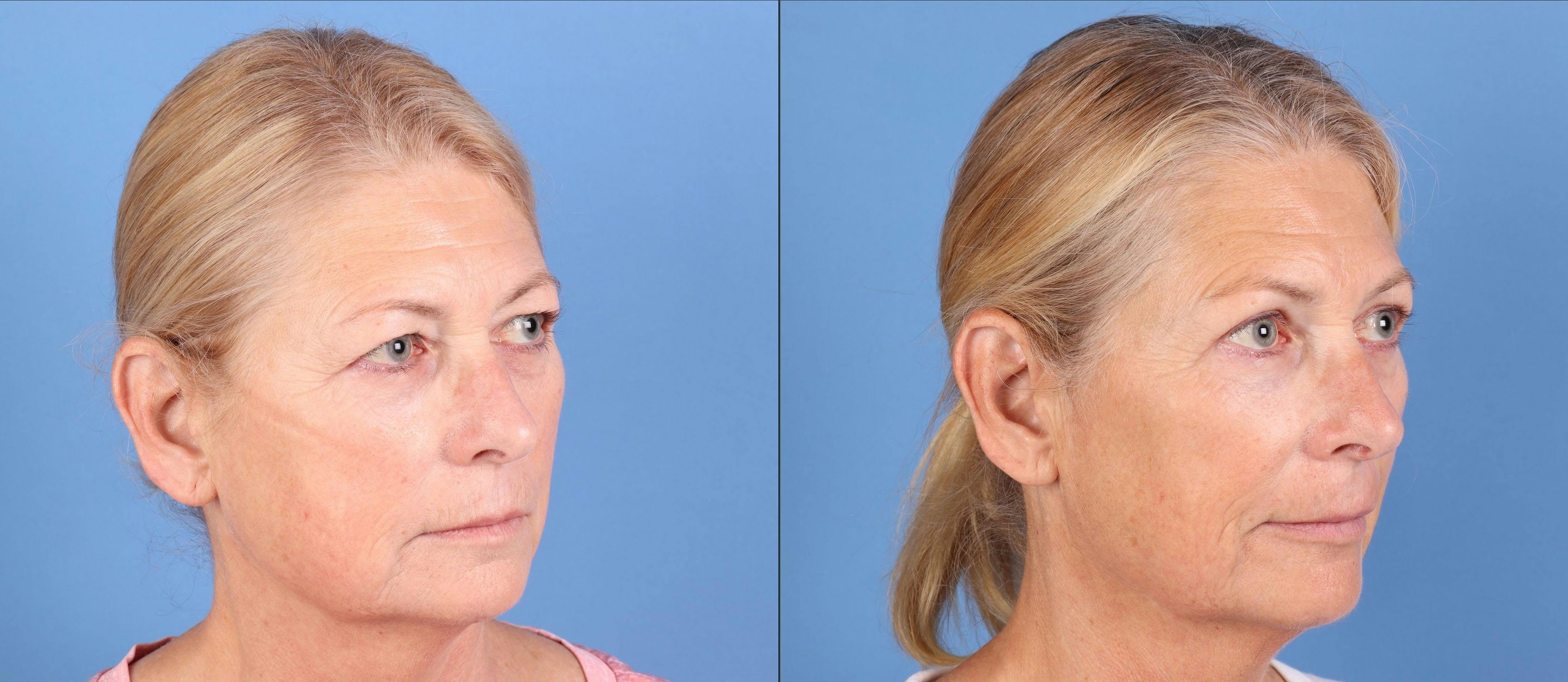 Eyelid Surgery (Upper Blepharoplasty) Before & After Gallery - Patient 317418 - Image 2