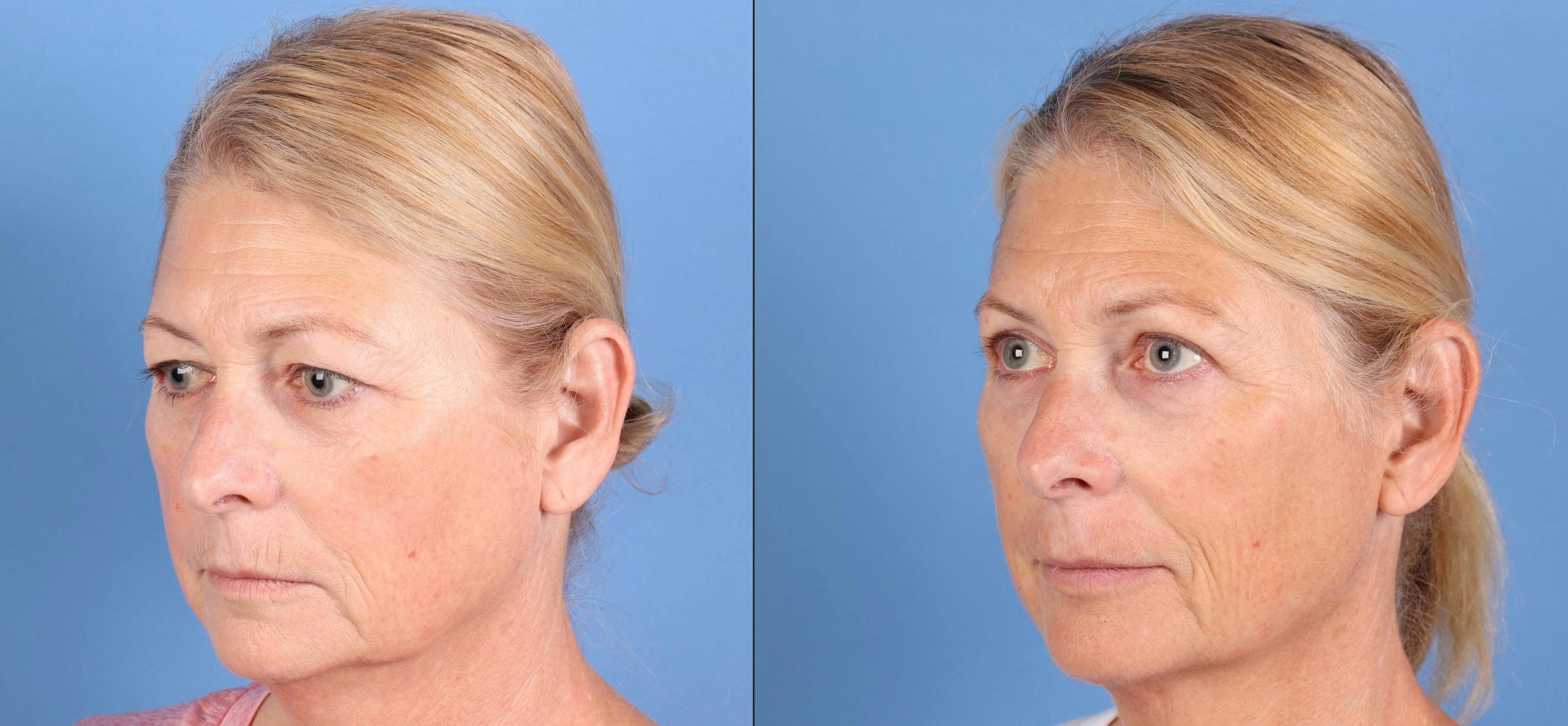 Eyelid Surgery (Upper Blepharoplasty) Before & After Gallery - Patient 317418 - Image 3