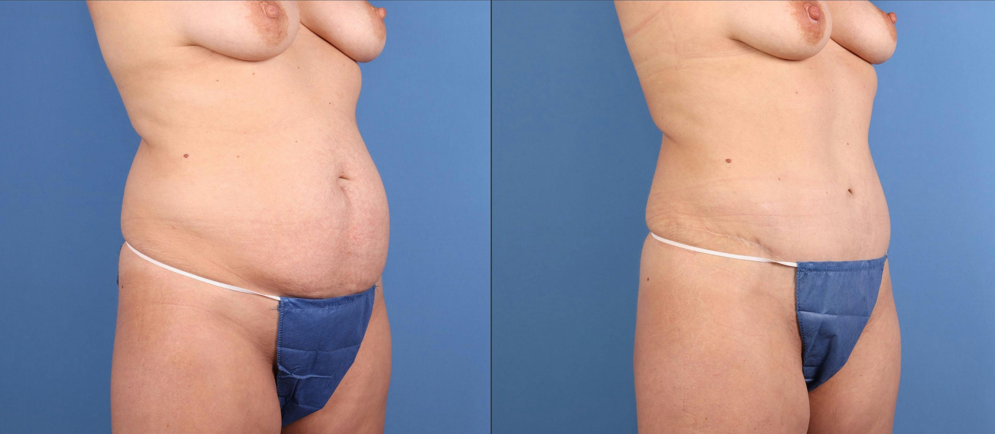 Tummy Tuck Before & After Gallery - Patient 294341 - Image 2