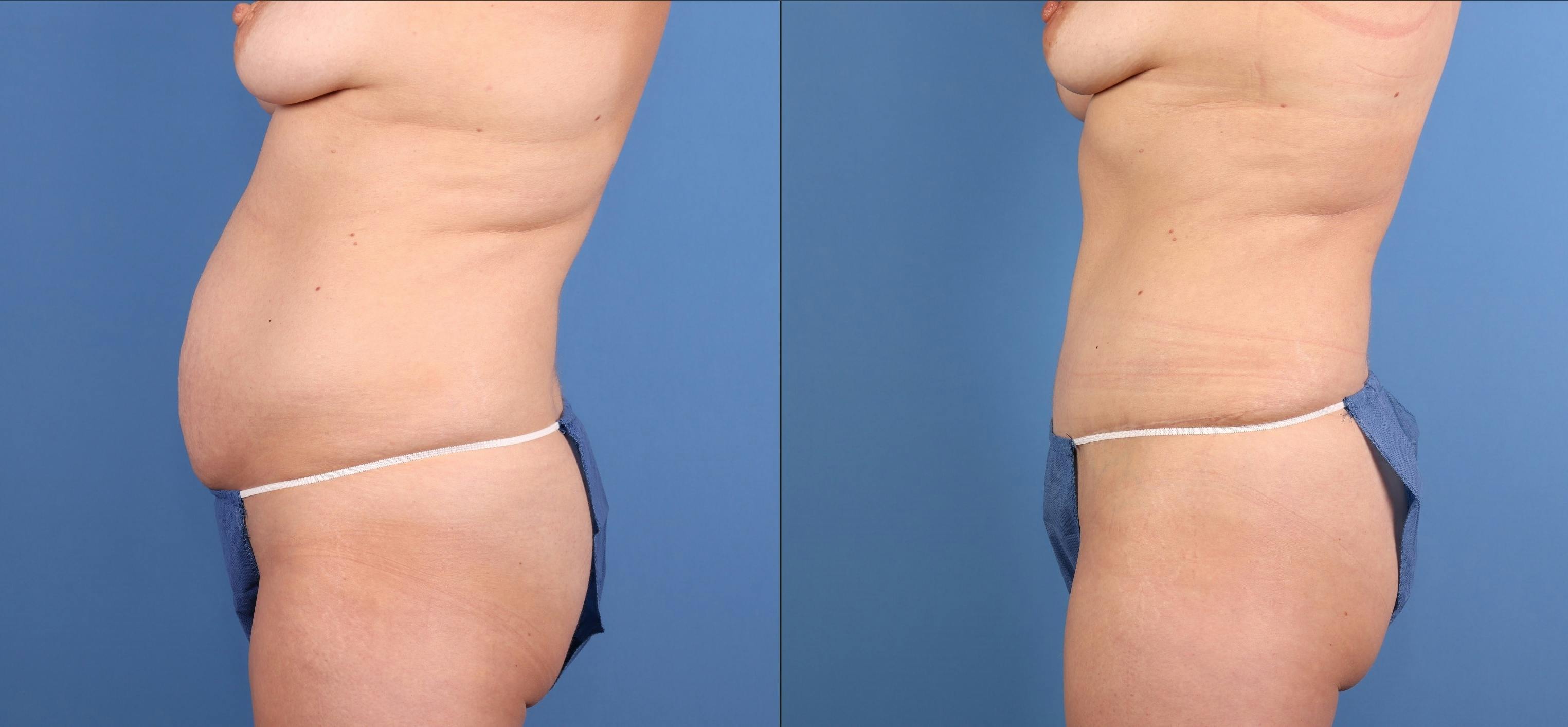 Tummy Tuck Before & After Gallery - Patient 294341 - Image 5