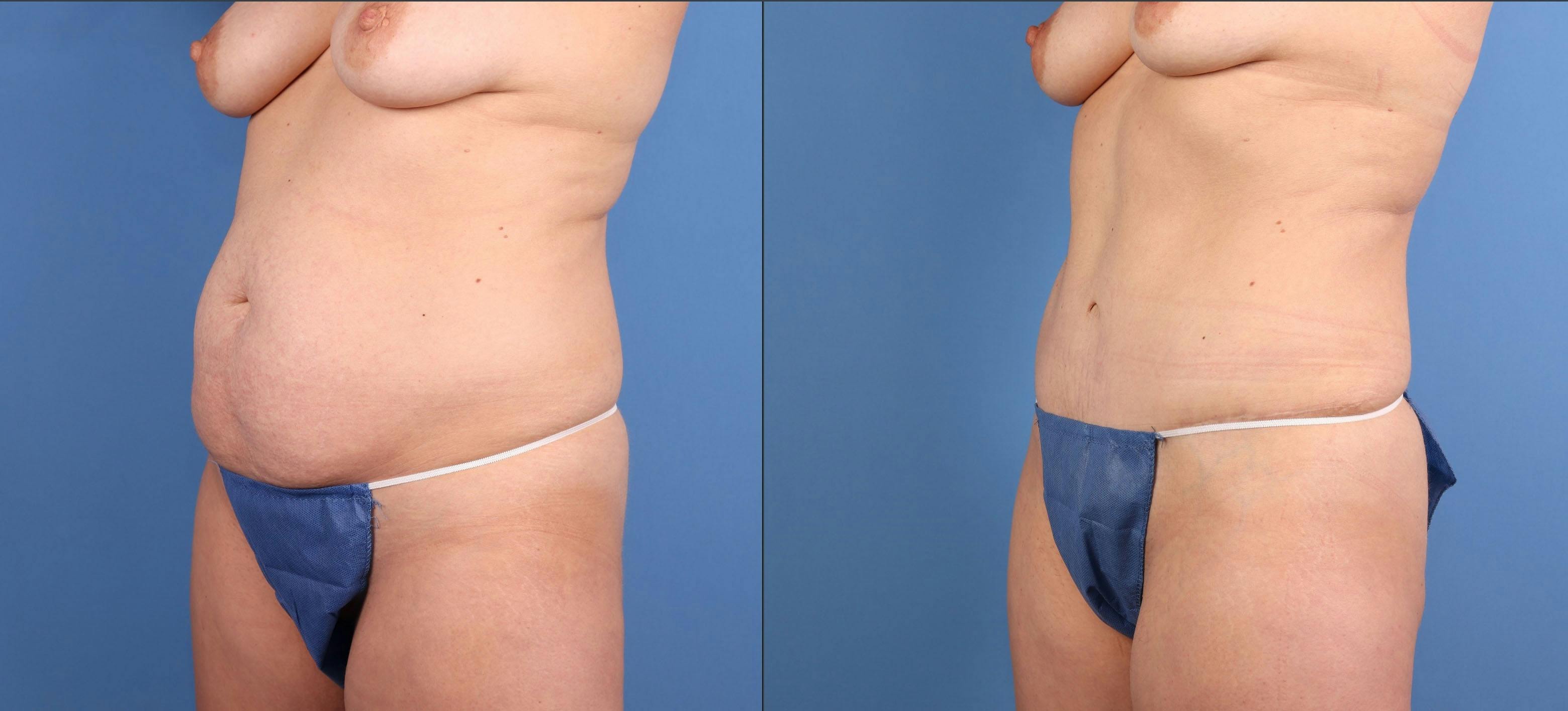 Tummy Tuck Before & After Gallery - Patient 294341 - Image 4