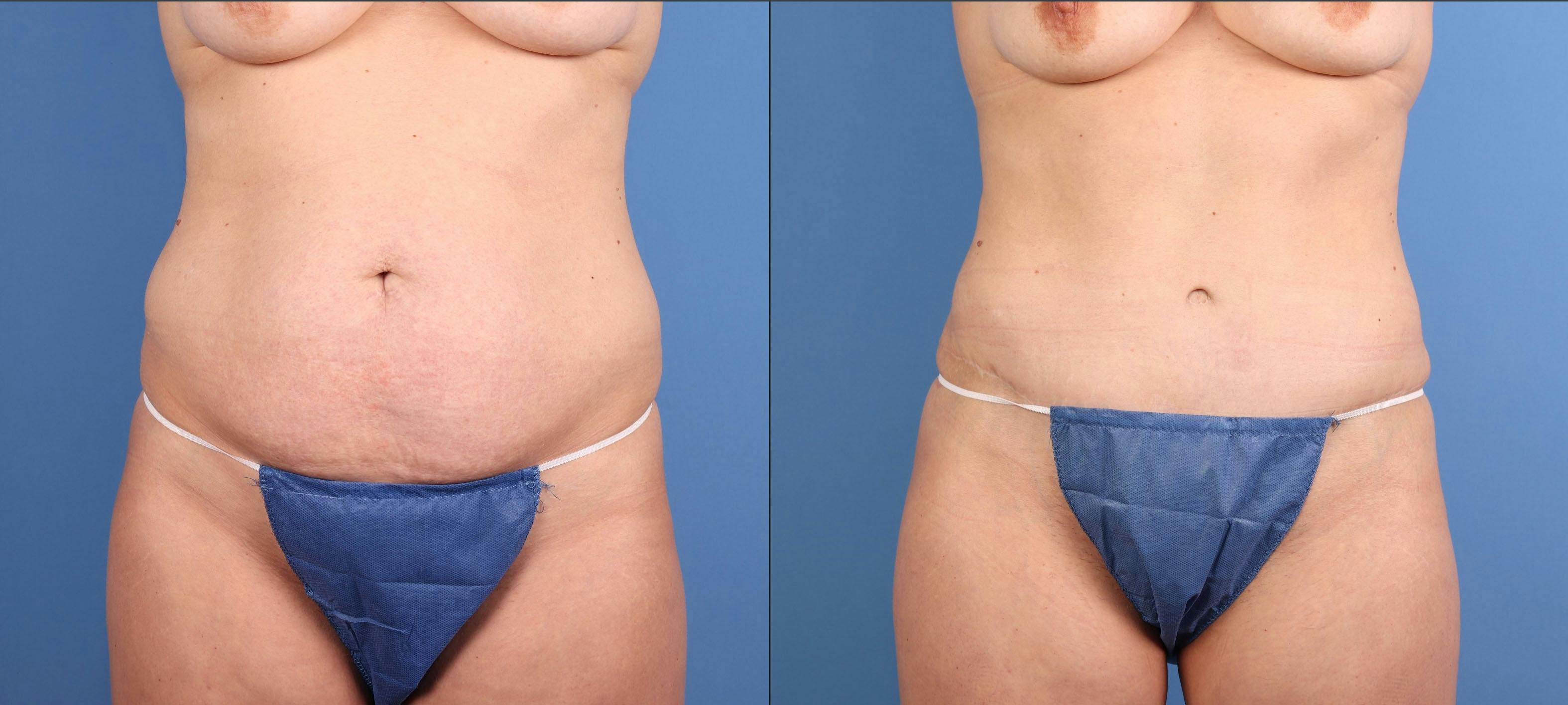 Tummy Tuck Before & After Gallery - Patient 294341 - Image 1