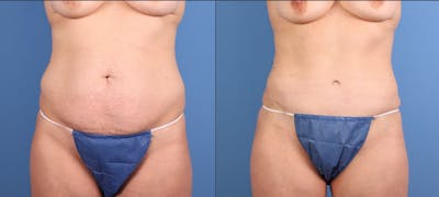 Tummy Tuck Before & After Gallery - Patient 294341 - Image 1
