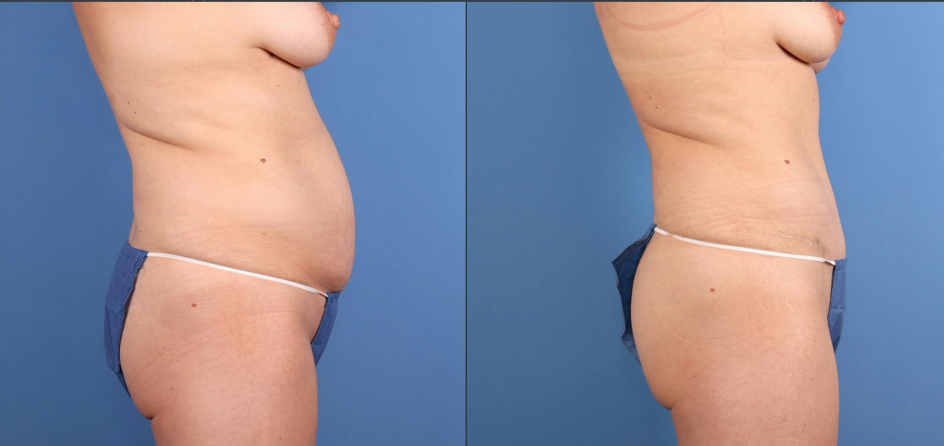 Tummy Tuck Before & After Gallery - Patient 294341 - Image 3