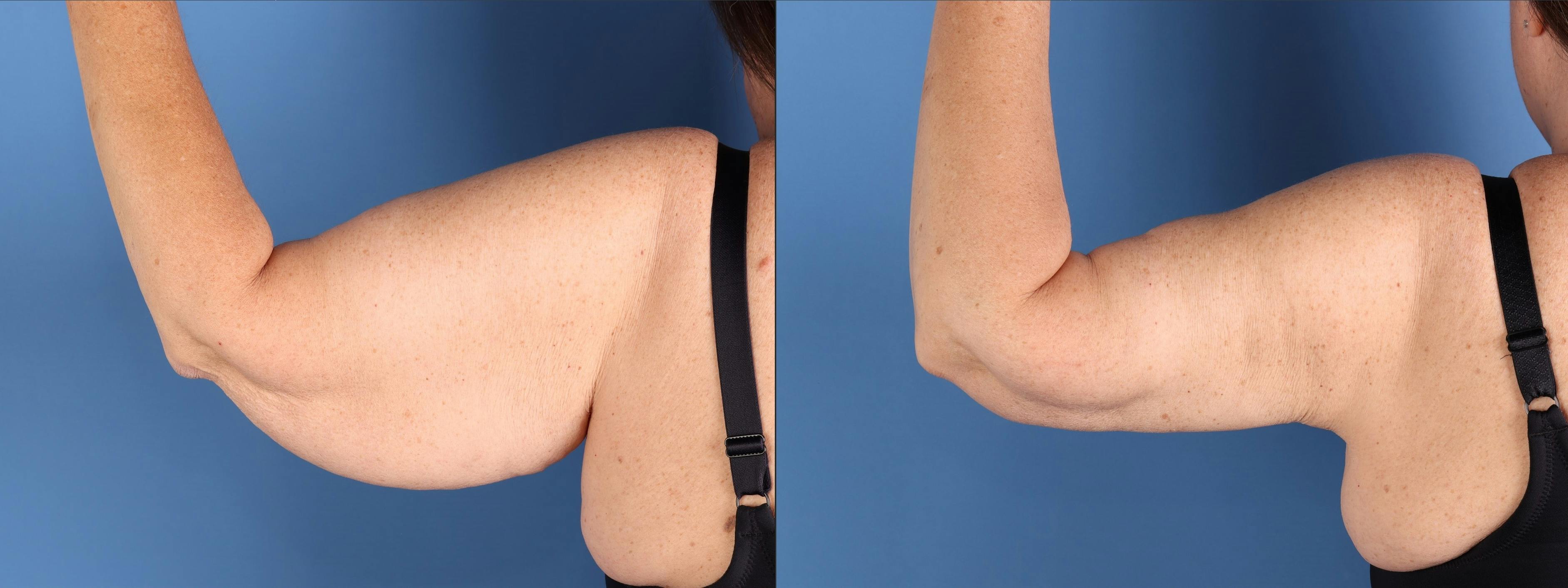 Arm Lift Before & After Gallery - Patient 232912 - Image 4