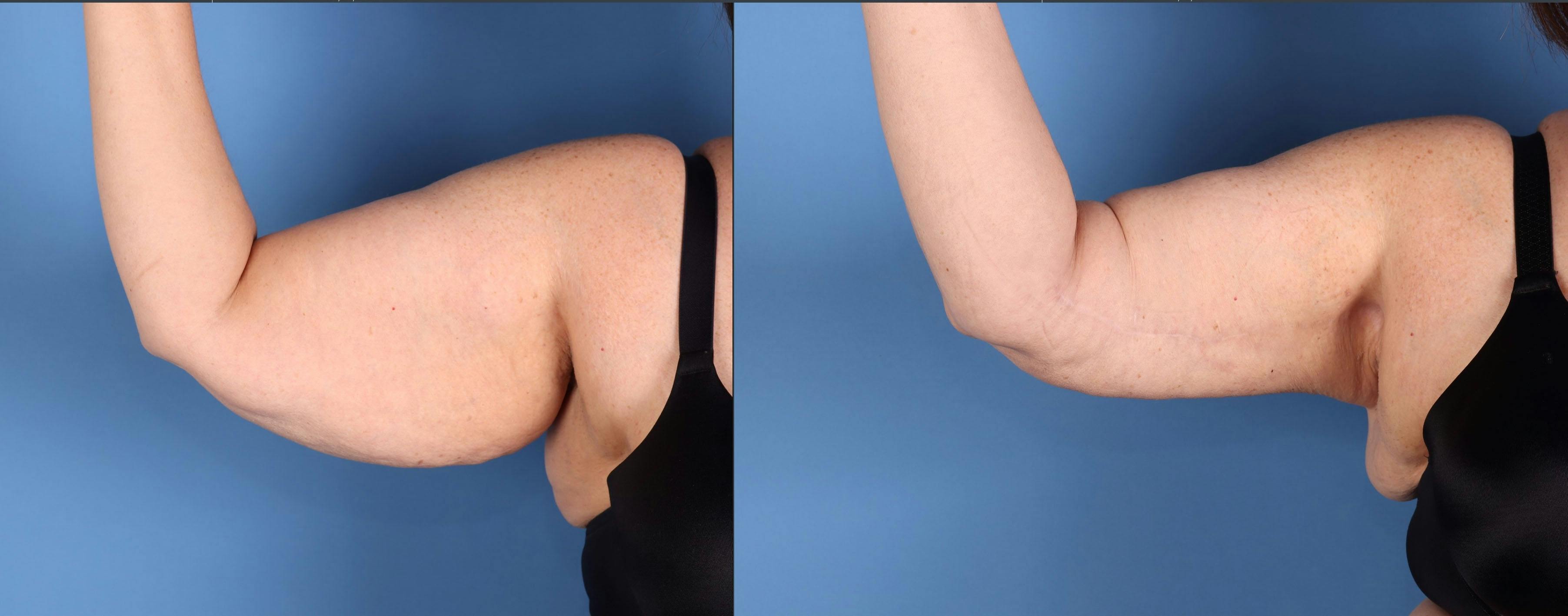 Arm Lift Before & After Gallery - Patient 232912 - Image 3