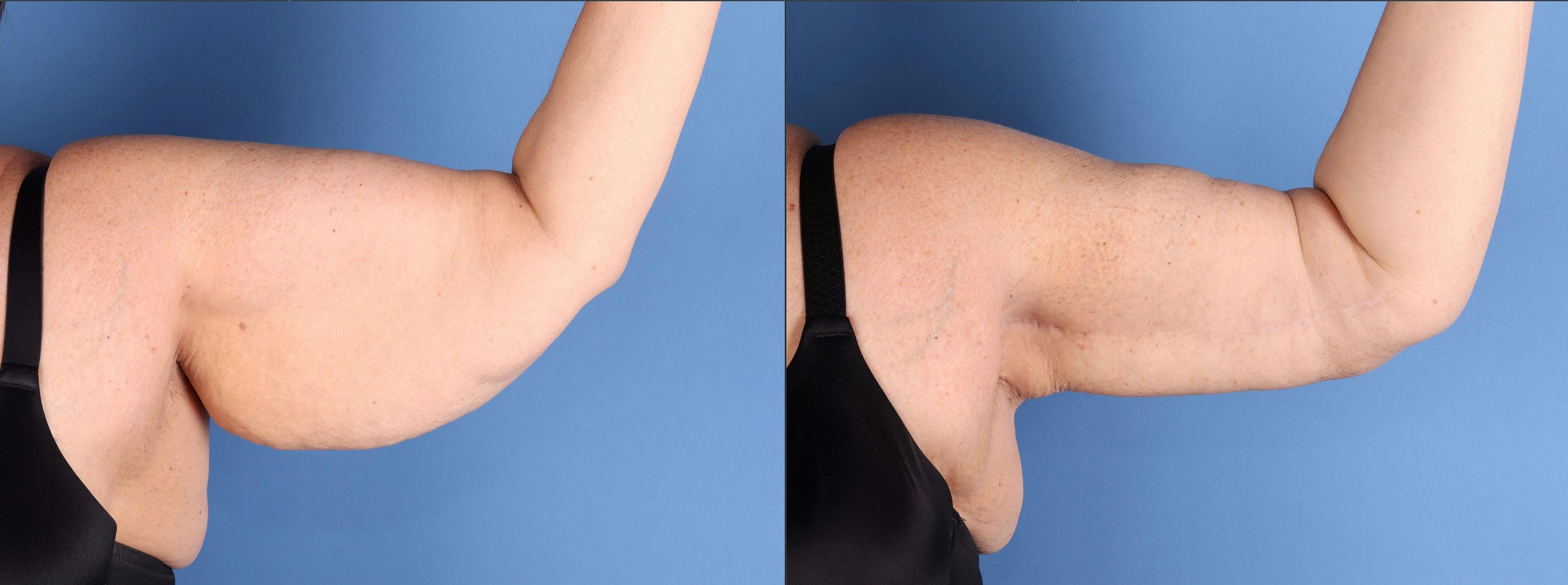 Arm Lift Before & After Gallery - Patient 232912 - Image 2
