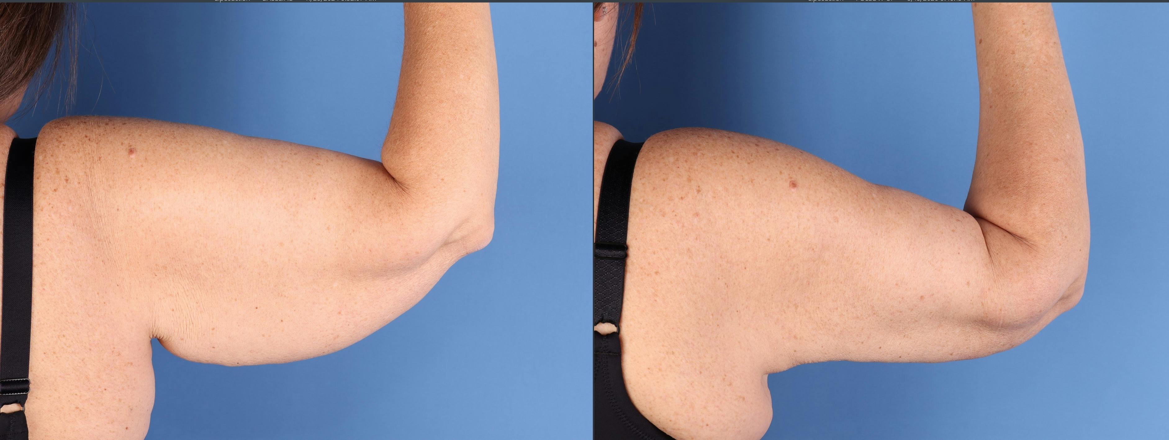 Arm Lift Before & After Gallery - Patient 232912 - Image 1