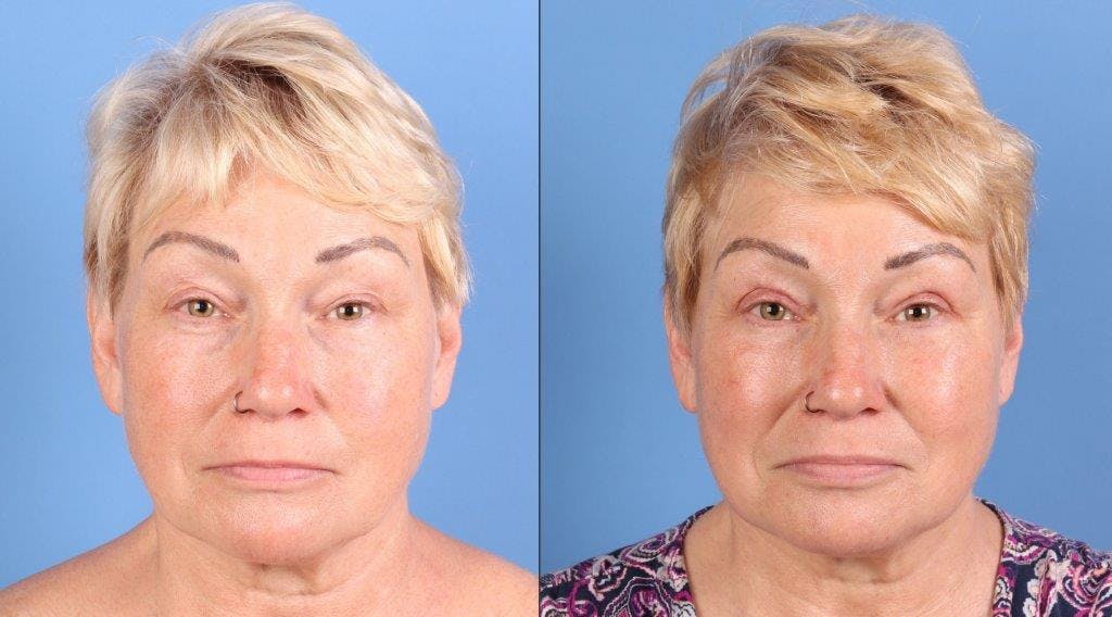 Eyelid Surgery (Upper Blepharoplasty) Before & After Gallery - Patient 344883 - Image 1