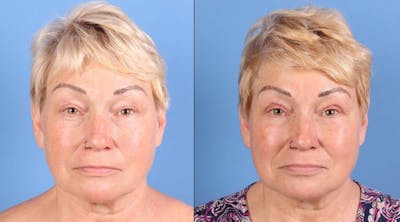 Eyelid Surgery (Upper Blepharoplasty) Before & After Gallery - Patient 344883 - Image 1
