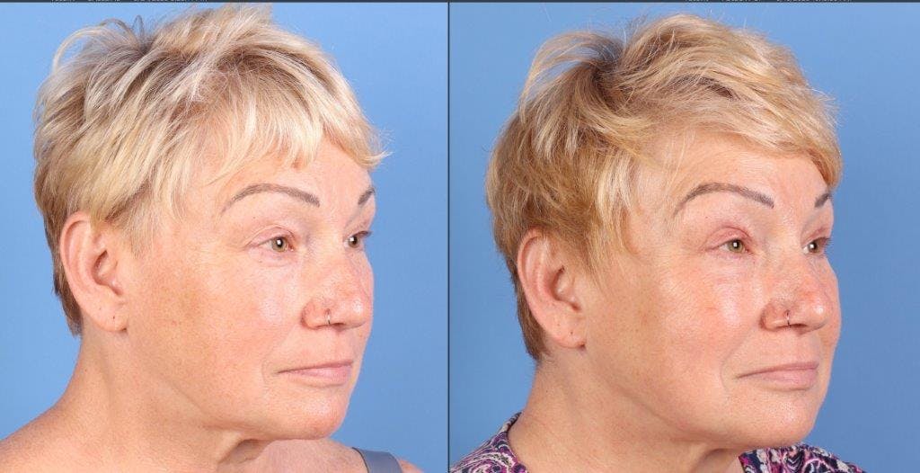 Eyelid Surgery (Upper Blepharoplasty) Before & After Gallery - Patient 344883 - Image 2