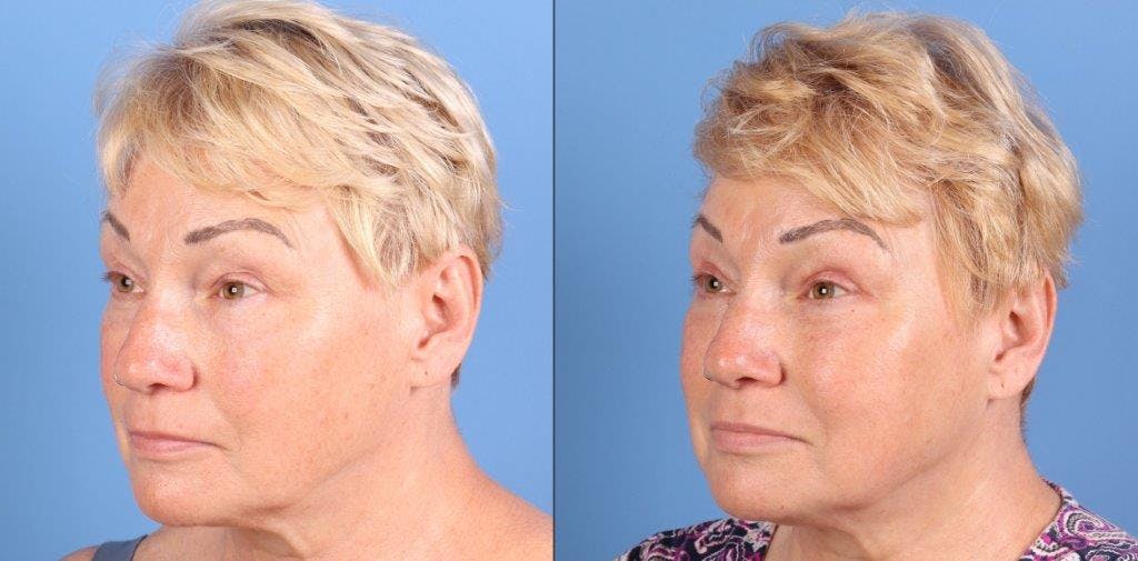 Eyelid Surgery (Upper Blepharoplasty) Before & After Gallery - Patient 344883 - Image 3