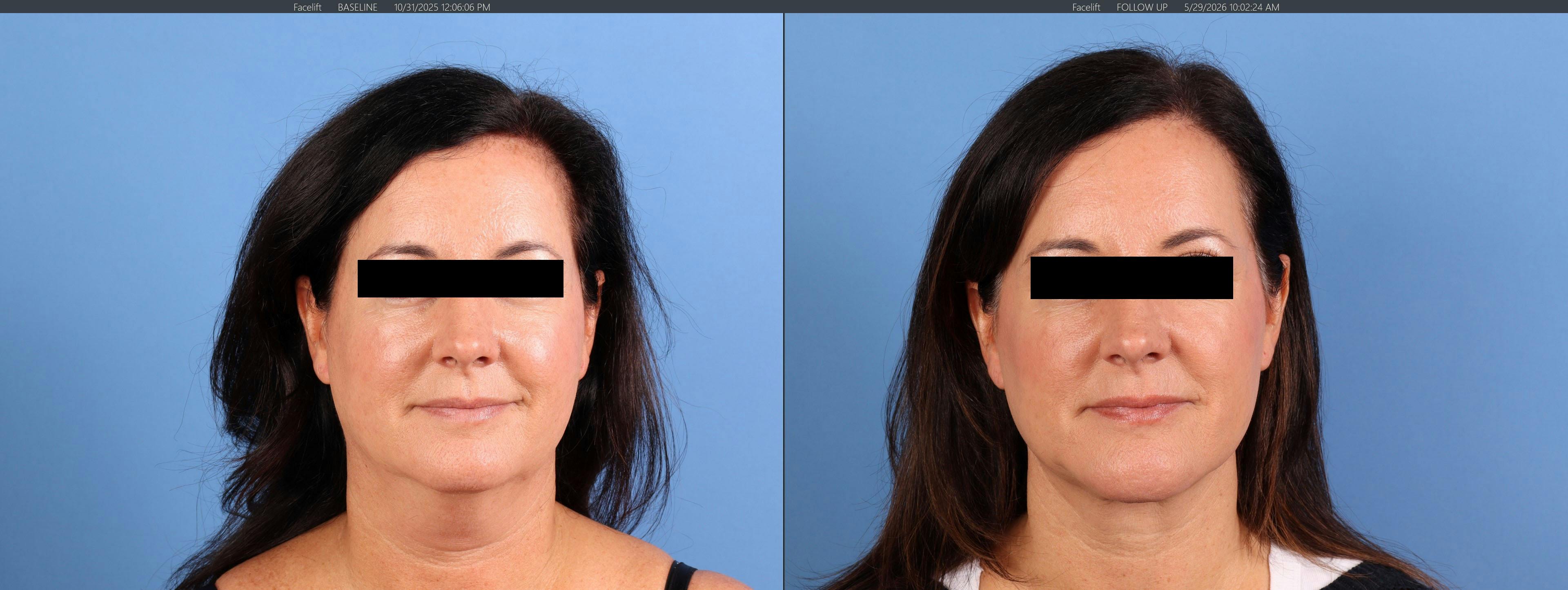 Chin Implant Before & After Gallery - Patient 626911 - Image 3