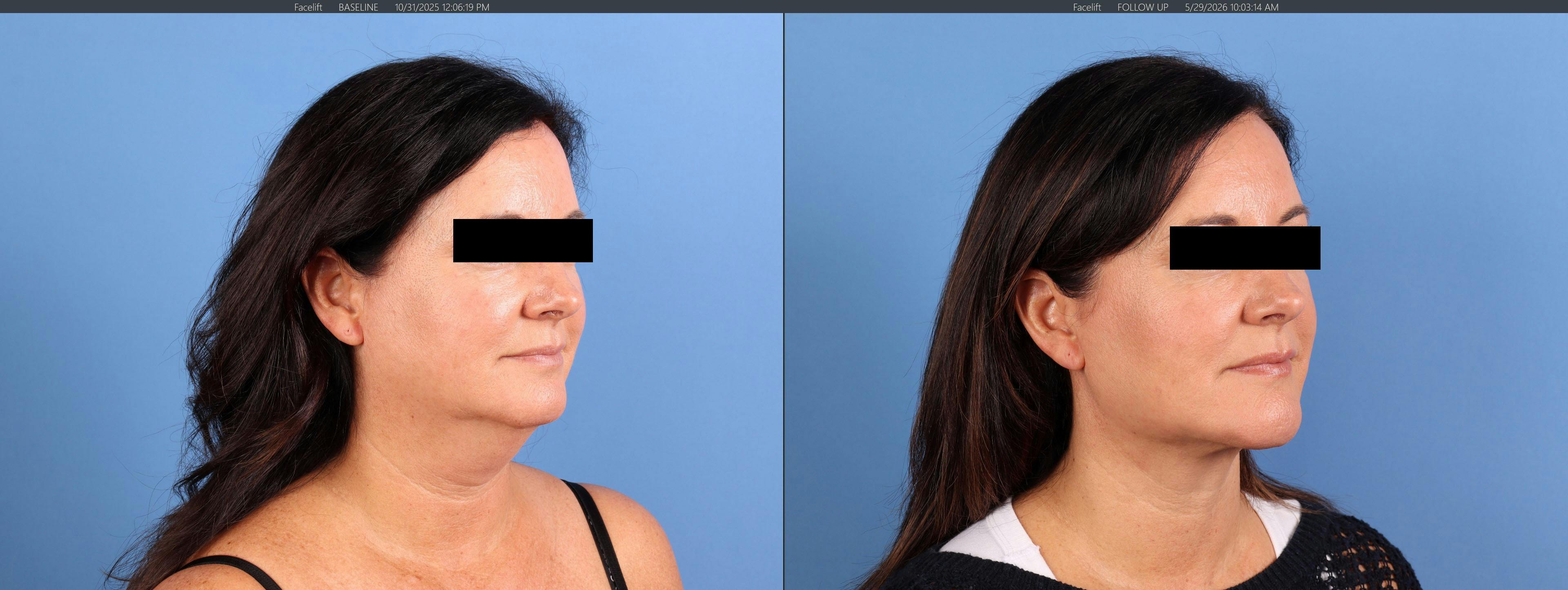 Chin Implant Before & After Gallery - Patient 626911 - Image 2