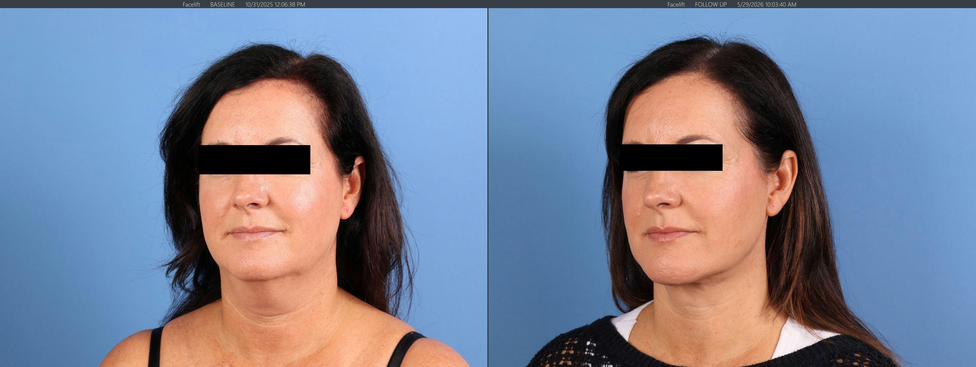 Chin Implant Before & After Gallery - Patient 626911 - Image 4