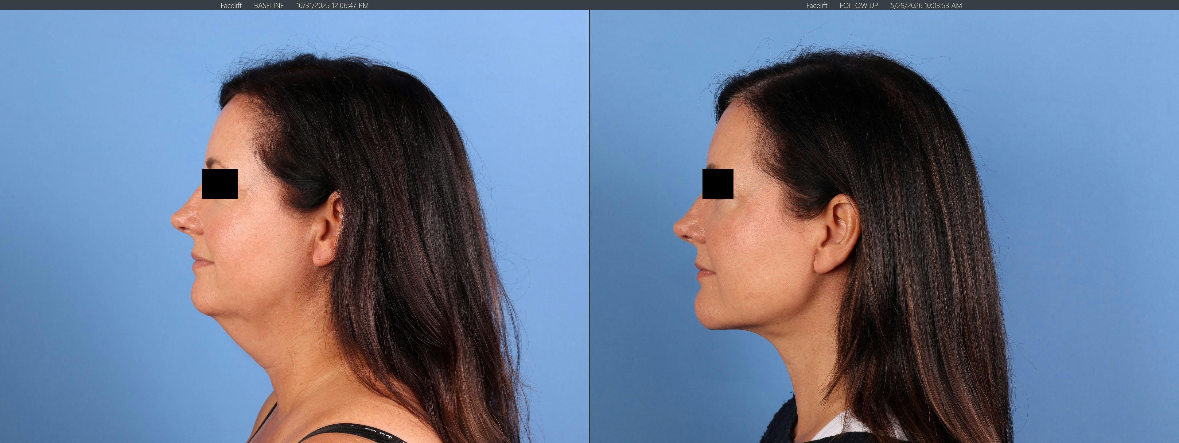 Chin Implant Before & After Gallery - Patient 626911 - Image 5