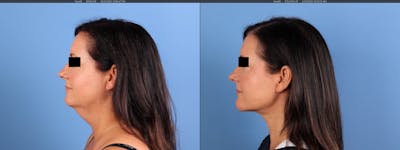 Neck Lift Before & After Gallery - Patient 255547 - Image 1