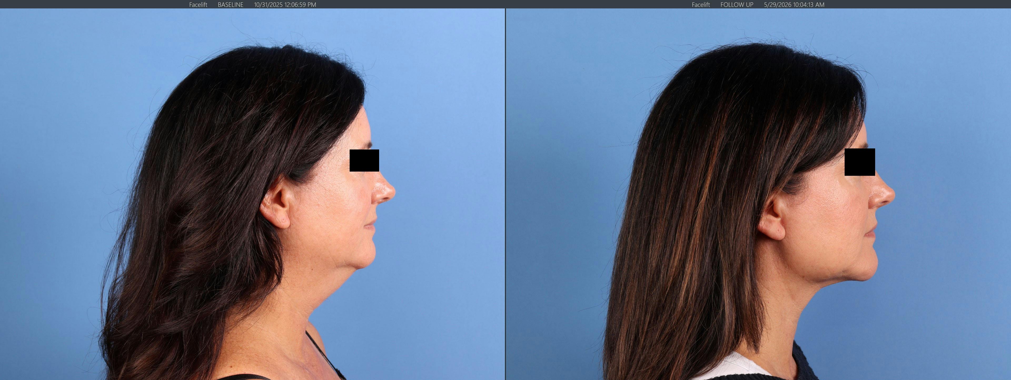Chin Implant Before & After Gallery - Patient 626911 - Image 1
