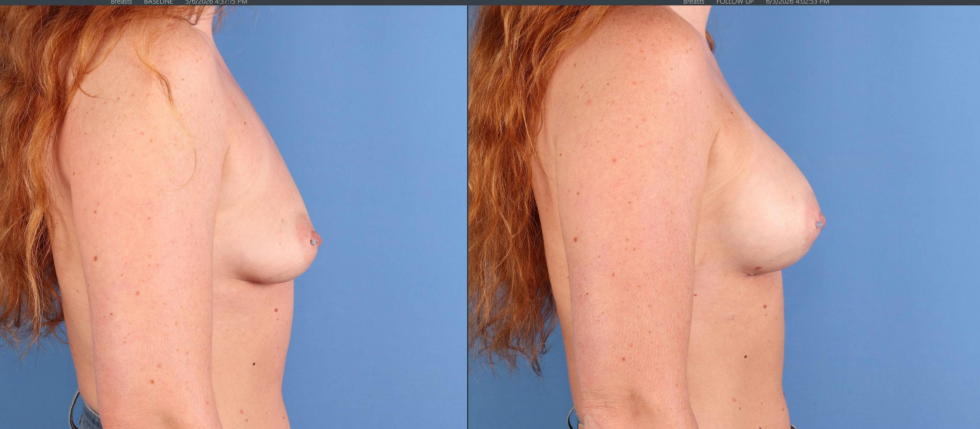 Breast Augmentation Before & After Gallery - Patient 772777 - Image 3