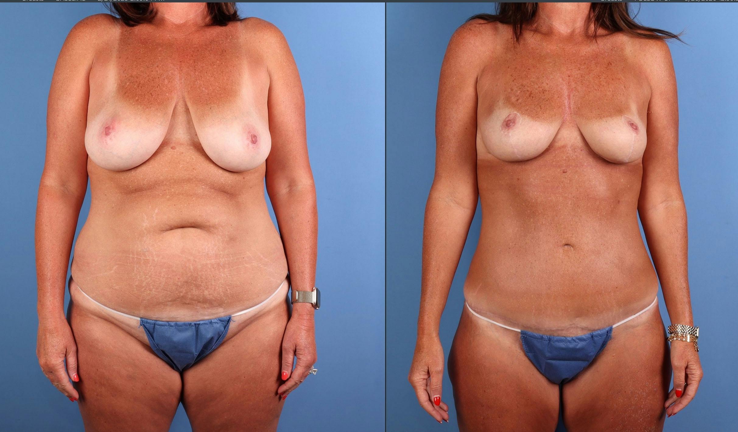 Mommy Makeover Before & After Gallery - Patient 399187 - Image 1