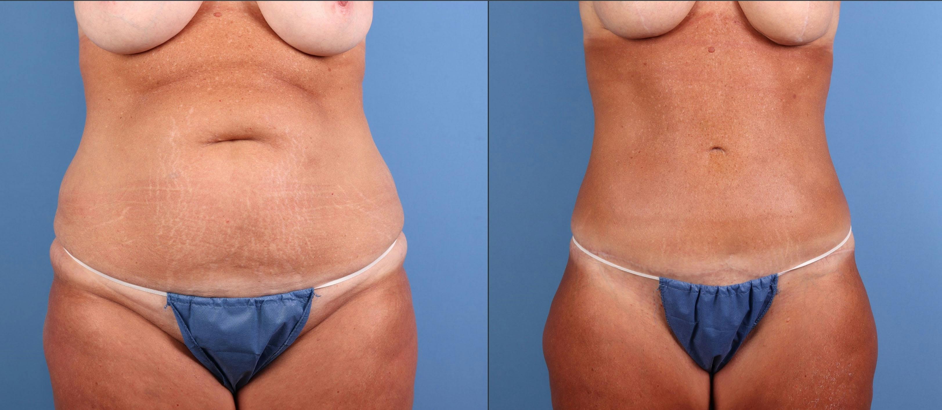 Abdomen Before & After Gallery - Patient 372813 - Image 1
